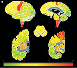 Whole-brain density map of TDP-43 distribution throughout central nervous system of ALS patients. Red, orange, and yellow depict areas of highest density of TDP-43 pathology. (Felix Geser and Nick Brandmeir, University of Pennsylvania; Archives of Neurology)